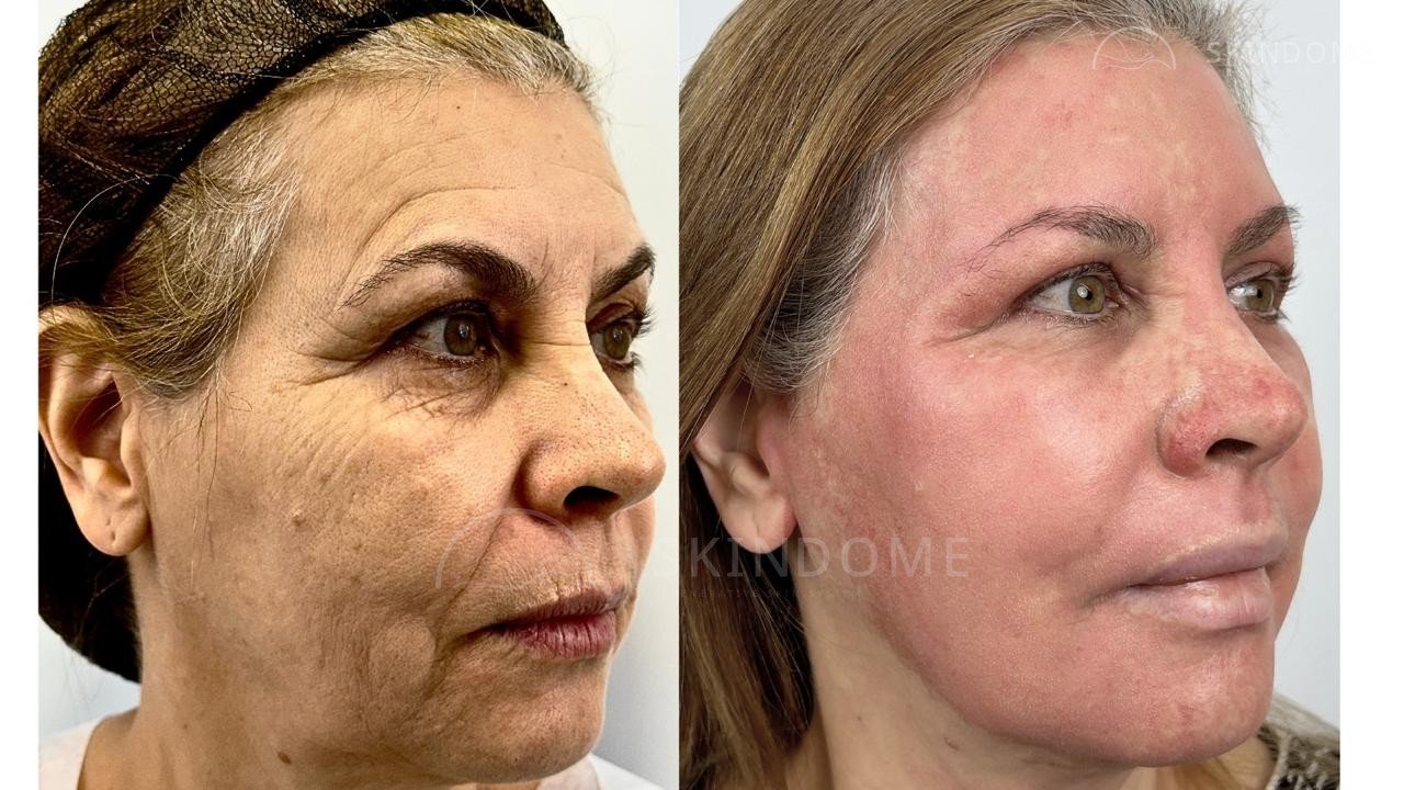 Caso clínico 07 SkinDome