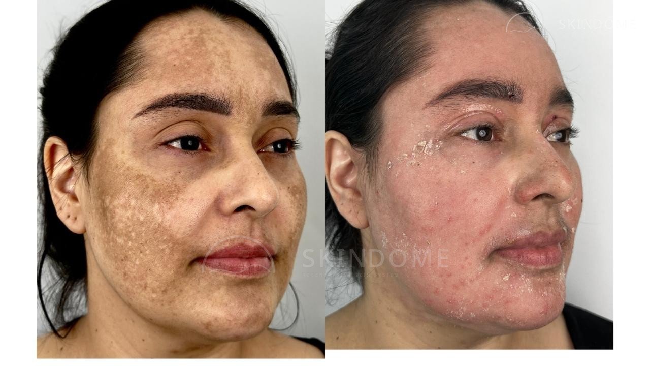 Caso clínico 10 SkinDome
